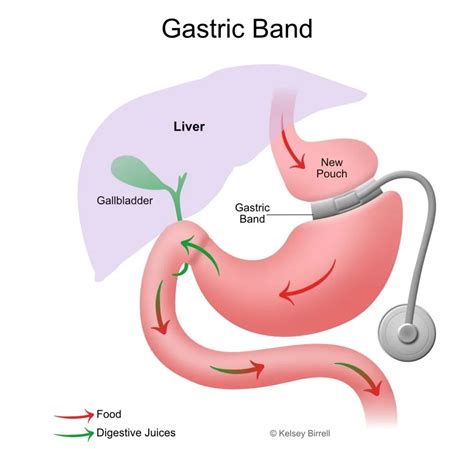 Gastric Band Surgery in Hyderabad | LivLife Hospitals
