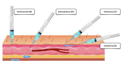 Injection Types 的图像结果