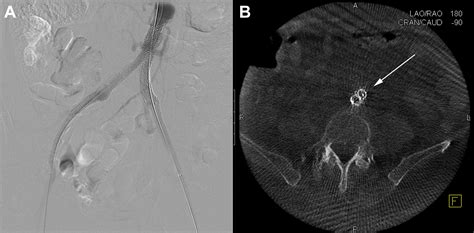 Utility of Intra-operative Cone Beam Computed Tomography in Endovascular Treatment of Aorto ...