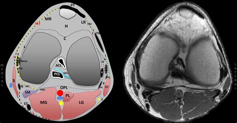 Posterolateral and Posteromedial Corner Injuries of the Knee - Radiologic Clinics