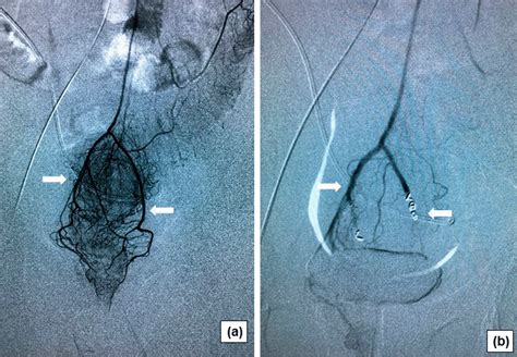 Comparison of different embolic particles for superior rectal arterial embolization of chronic ...