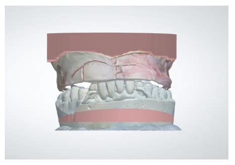 Current Status of Digital Complete Dentures Technology