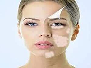 Buy Zyrex Vitiligo Nill Churn (Powder)-100 Gram An Ayurvedic Remedy For ...