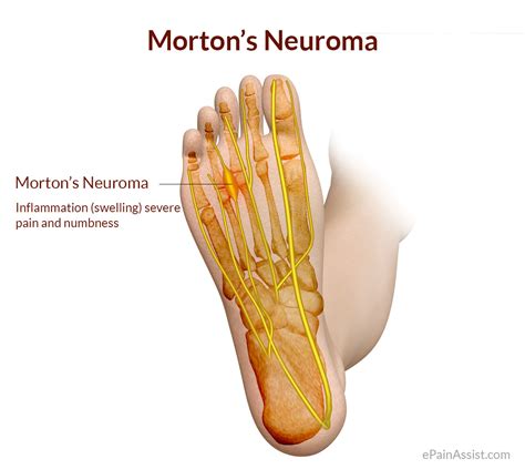 Morton’s Neuroma or Morton's Metatarsalgia or Plantar Neuroma|Causes|Symptoms|Treatment