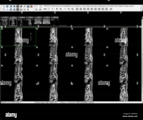 MRI L-S spine or lumbar spine sagittal view for diagnosis spinal cord compression Stock Photo ...