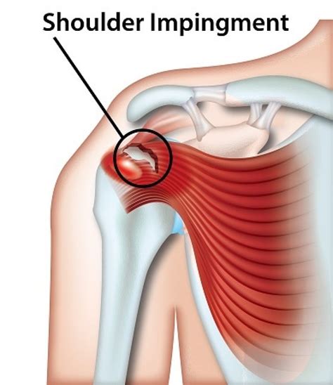 Shoulder Impingement Syndrome: Causes Symptoms, 54% OFF
