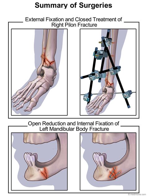Wrist Fracture Open Reduction And Internal Or Externa