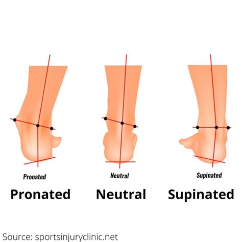 Running Shoes Pronation Vs Supination at Derrick Evans blog