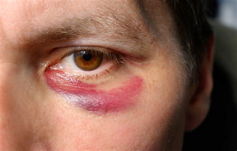 Chalazion vs Stye: Sababu, Dalili na Usimamizi Salama