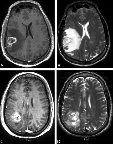 Fig 1. | MR Imaging Correlates of Survival in Patients with High-Grade Gliomas | American ...