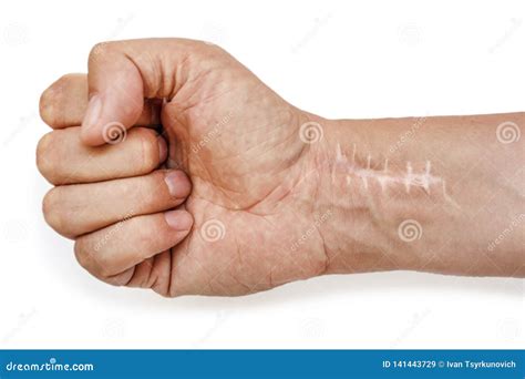 Scar with Stitches on the Wrist after Surgery. Fracture of the Bones of ...