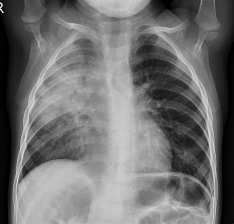 bacterial pneumonia – 肺炎を起こす細菌 – GJTU