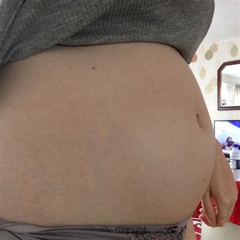 17 Weeks Pregnant With Triplets