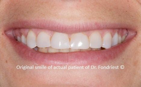 Kuvatulokset haulle celiac dental