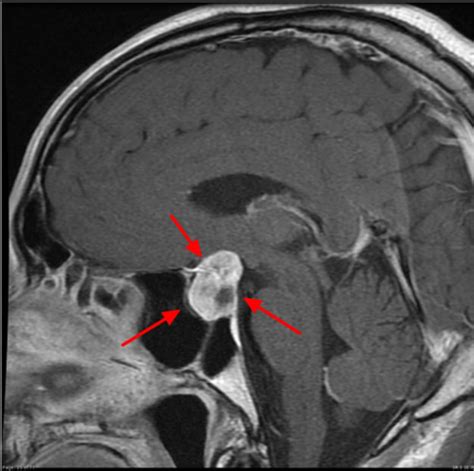 The Role of Imaging and Advanced Diagnostics in Pituitary Tumor Surgery ...