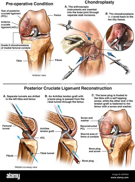 Torn Posterior Cruciate Ligament