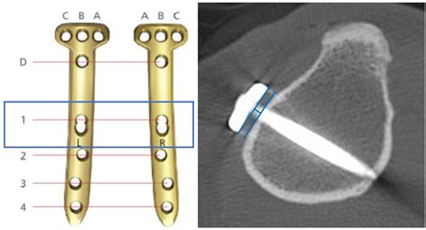Comparison of Anatomical Conformity between TomoFix Anatomical Plate ...