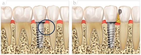 Clinical Effects of Interproximal Contact Loss between Teeth and ...