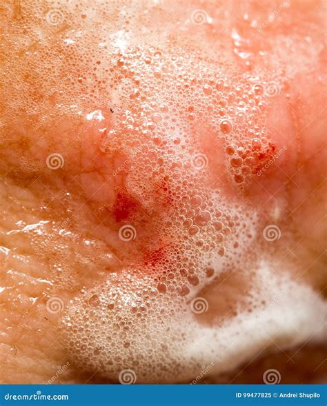 Blood on the Skin from a Cut in Hydrogen Peroxide Stock Image - Image of wounded, healing: 99477825