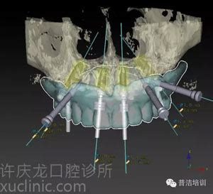 种植体品牌大全及全新价格分享,种牙什么牌子好?看了就知道_口腔行业资讯_皓齿口腔网