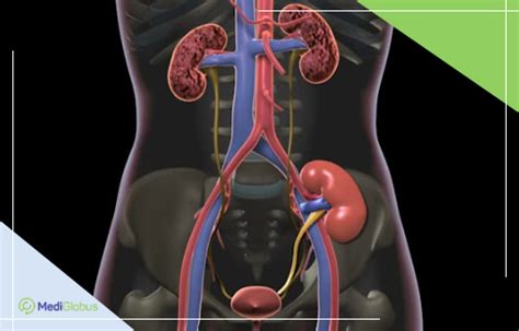 Что нужно знать о пересадке почки? | Medical Tourism with MediGlobus ...