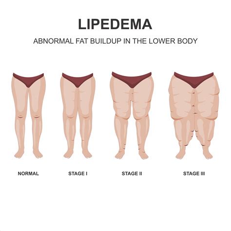 Understanding Lipedema: The Often Misdiagnosed Fat Disorder – Vascular and Veins Care