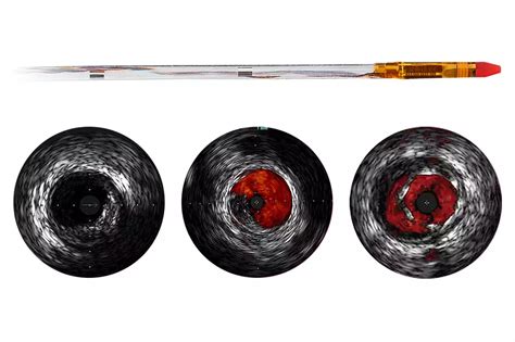 IntraSight Interventional Applications Platform | Philips Healthcare