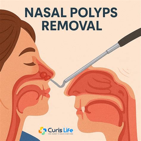 Nasal Polyp Removal
