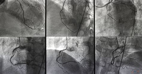 Image result for How Angiogram Is Done