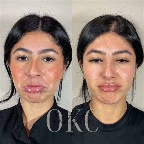 Tox Before and After Images - LOU LOU MED SPA