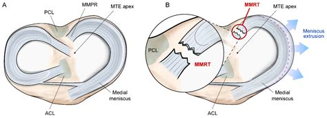 Medial Meniscus Posterior Root Tear: How Far Have We Come and What Remains?