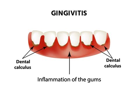 Gingivitis: síntomas, causas, diagnóstico y tratamiento