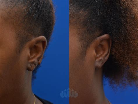 Earlobe Repair Before and After Pictures Case 86 | Charlotte, NC | Dilworth Facial Plastic Surgery