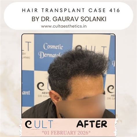Hair Transplant Case 416 Results | Before & After