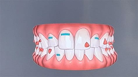 Image result for Invisalign ClinCheck