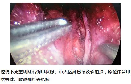 颌面耳鼻喉肿瘤科甲状腺肿瘤微创手术稳步发展-天津市肿瘤医院-北方网企业建站