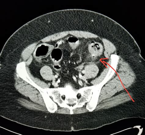 Ct Scan For Diverticulitis at Carlos Pratt blog