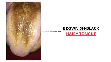 Hairy Tongue: What It Is, What Causes It, and How to Treat It