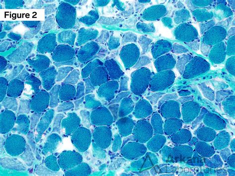 Critical Illness Myopathy | Neuro Notes | Arkana Laboratories
