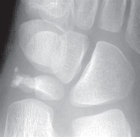 Image result for What iOS a Developmental Variation