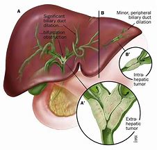 bile duct 的图像结果