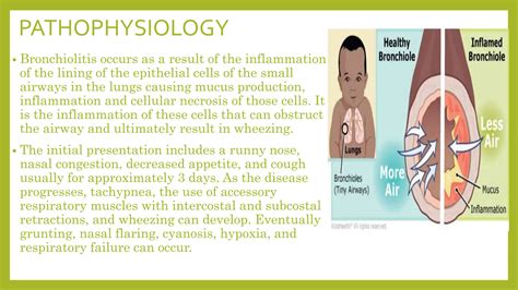 BRONCHIOLITIS & PNEUMONIA, pediatrics and adult | PPTX