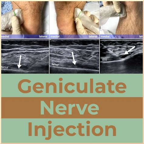 Genicular Nerve Injections - Sports Medicine Review