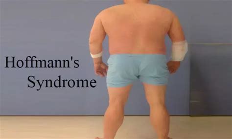 Rare case of Hoffmann's syndrome necessitating forearm fasciotomy: a ...