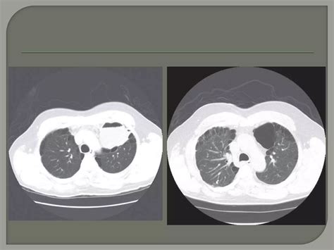 Bullous disease of lung.pptx