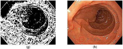 Computer-Based Diagnosis of Celiac Disease by Quantitative Processing ...