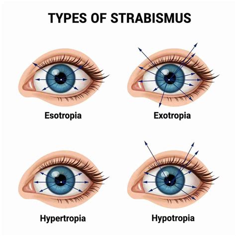 Crossed Eyes (Strabismus): Causes & Treatment Options