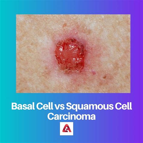 Basal Cell vs Squamous Cell Carcinoma: Difference and Comparison