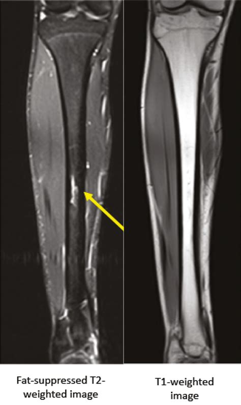 Stress Fracture Tibia Bone Scan