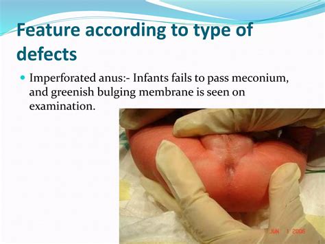 Anorectal malformation .pptx